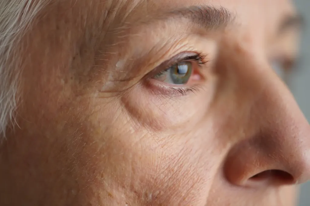 Structure de la peau vieillissante